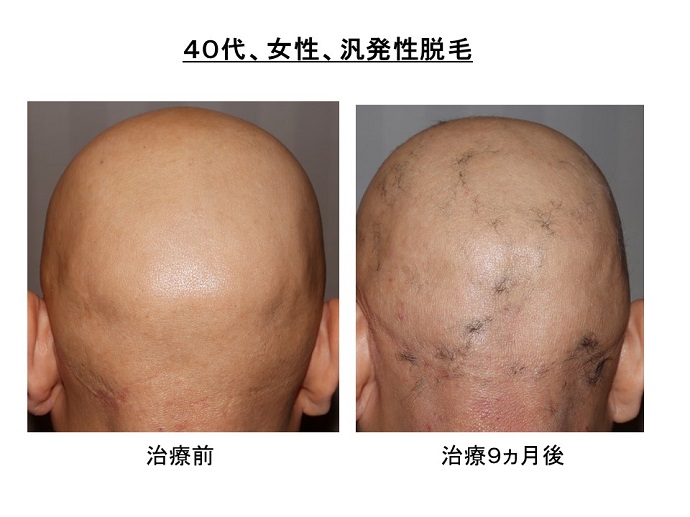 円形脱毛症　病院